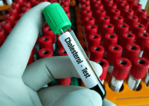 콜레스테롤 검사를 위한 혈액 샘플을 손에 들고 있는 장면, 검사관이 실험용 튜브를 확인하는 모습